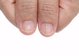 What causes white spots on nails?