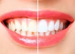 5 Natural Herbs That Helps To Whiten Teeth